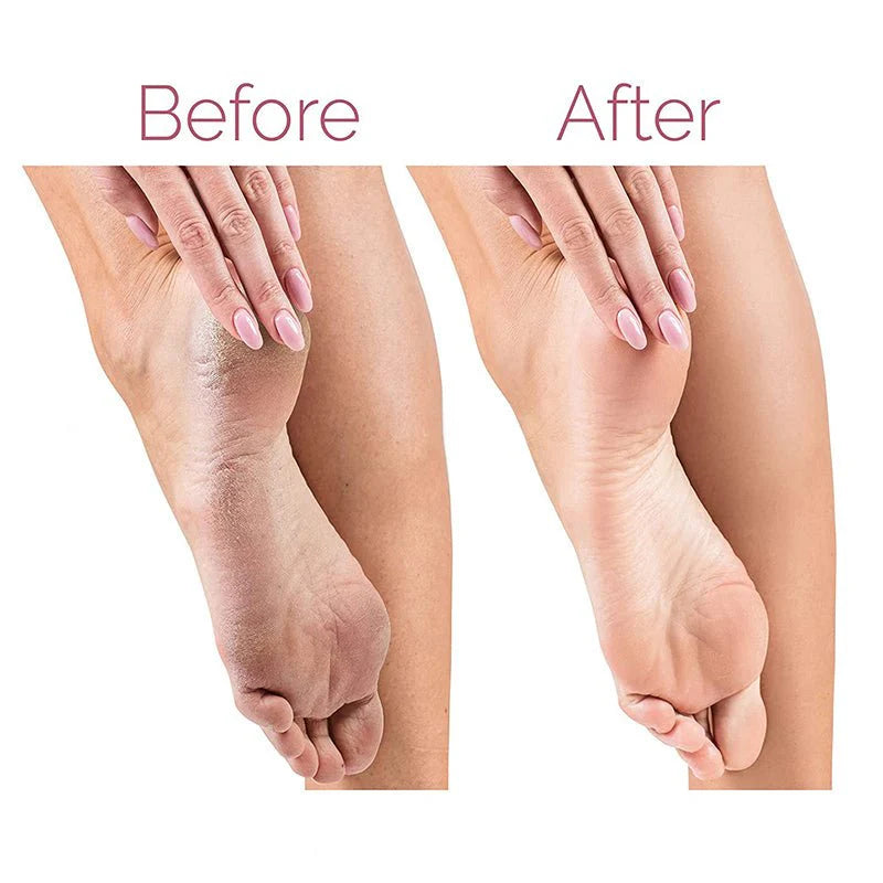 Electric Pedicure Foot File Callus Remover مبرد قدم كهربائي لإزالة الجلد الميت والطبقات السميكة